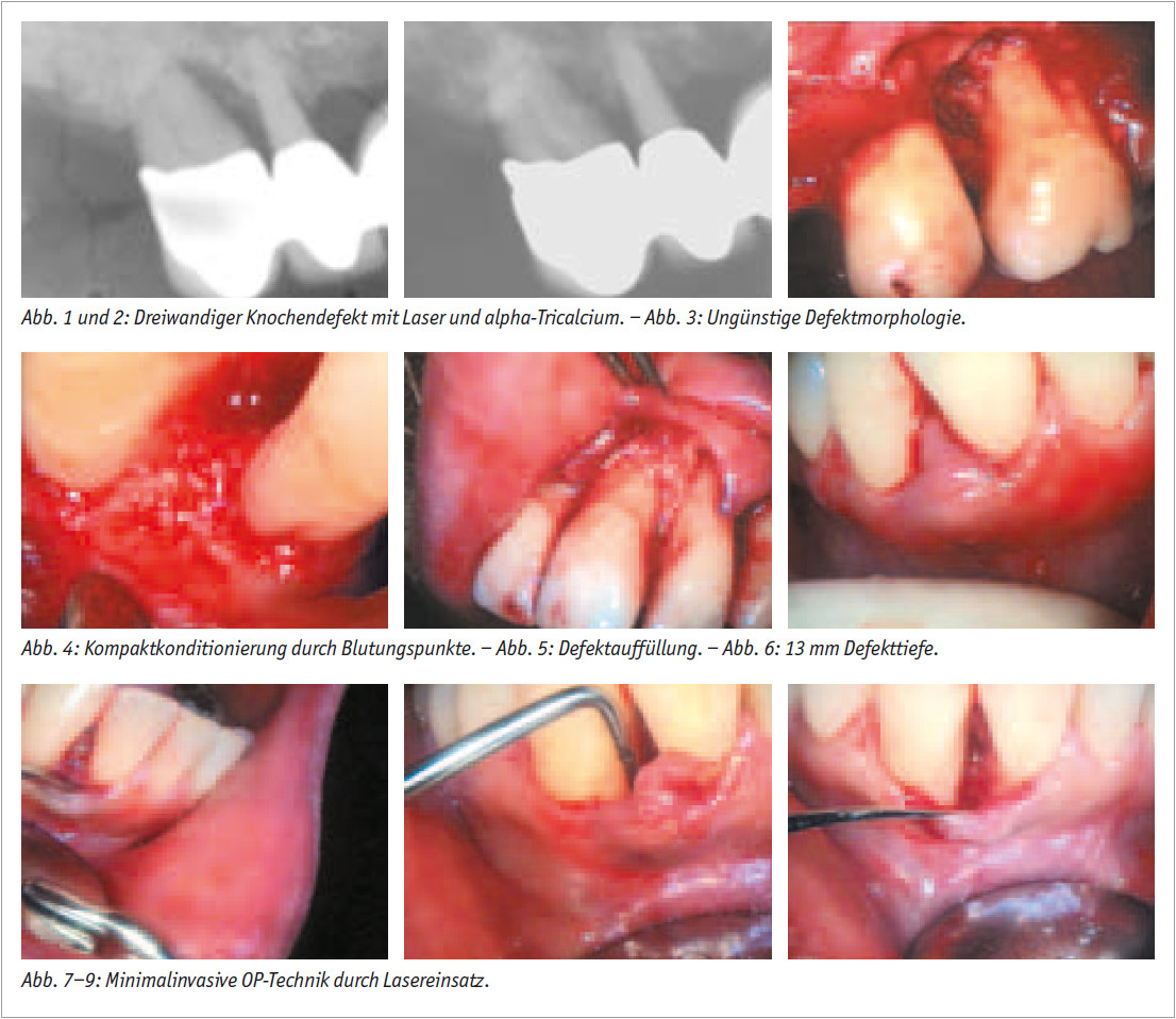 Laserunterstützte regenerative Parodontaltherapie