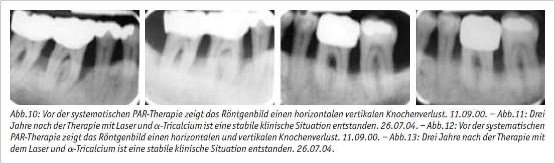 Laserunterstützte regenerative Parodontaltherapie