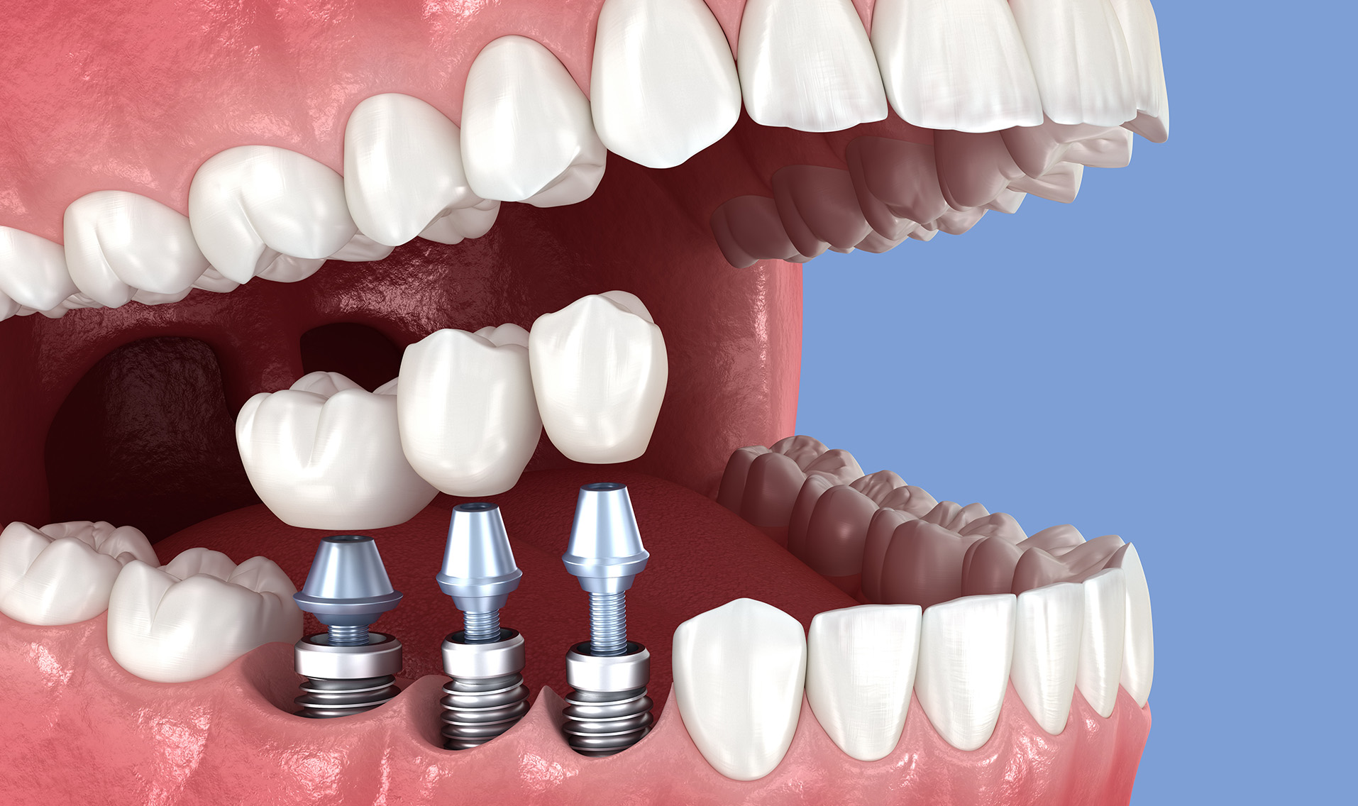 Periimplantitis - Sieben Warnzeichen, die Sie bei Ihrem Zahnimplantat ernst nehmen sollten - shutterstock_2630526299_Alex Mit